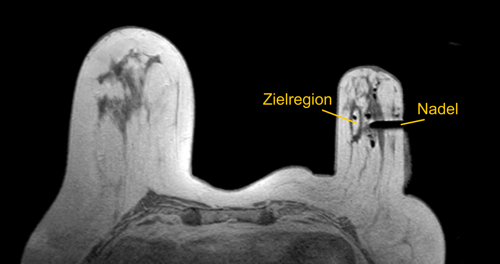 MRT-gezielte Stanzbiopsie