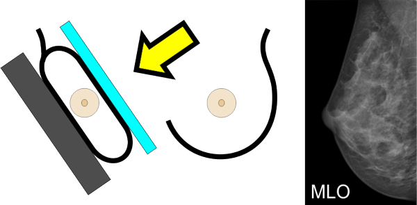 Mammographie mlo Schema